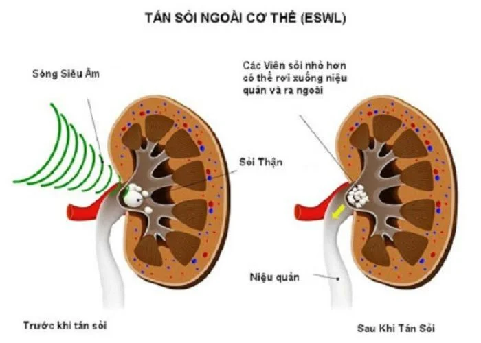 tan-soi-bang-song-sieu -am